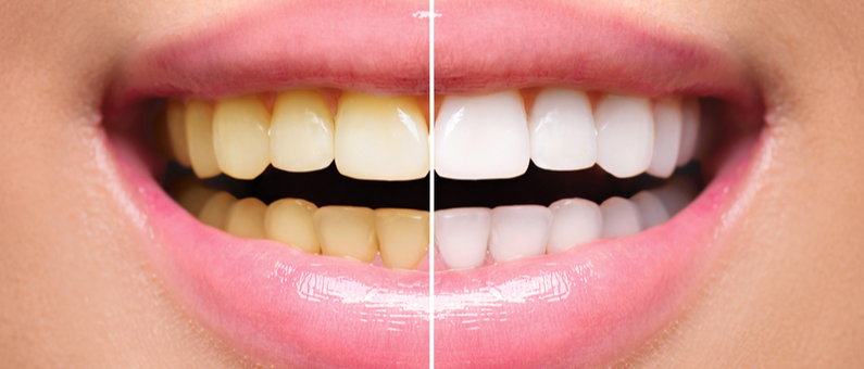 teeth whitening in Illinois