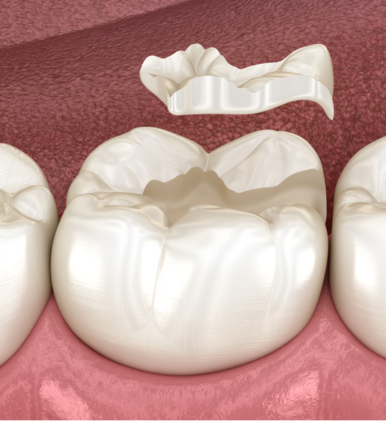Fillings and Crowns | Aristo Dental