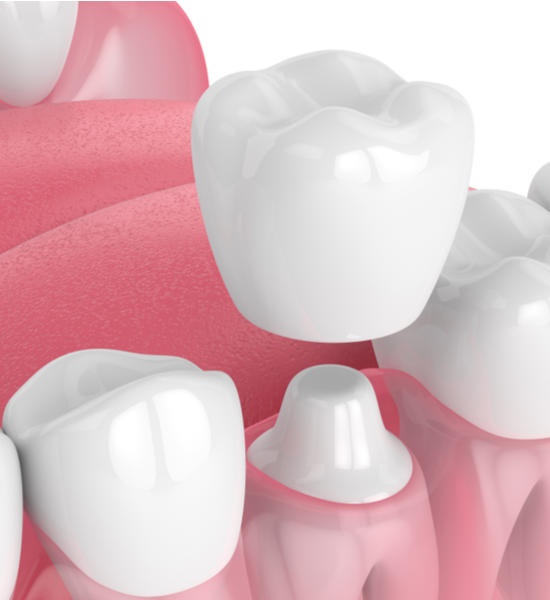 Dental Crowns at Aristo Dental | Wheeling IL