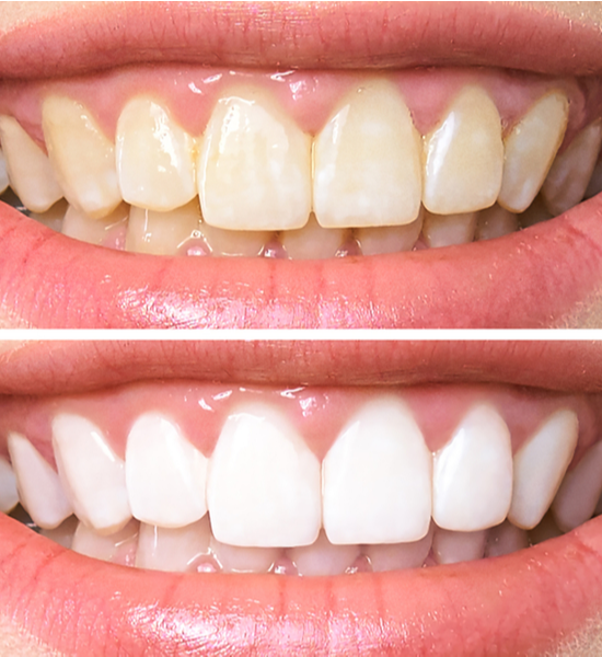 Teeth Whitening | Aristo Dental