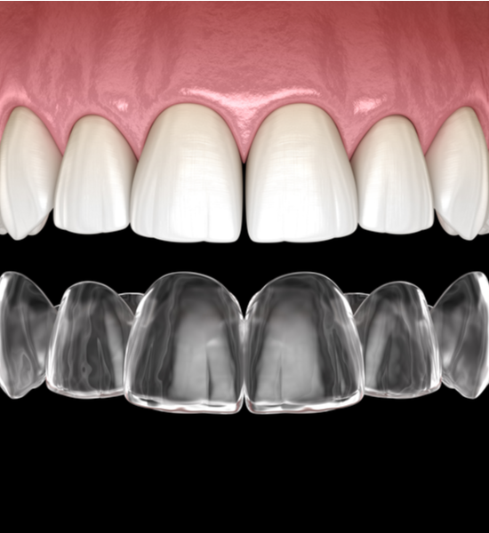 SureSmile Clear Aligners | Aristo Dental