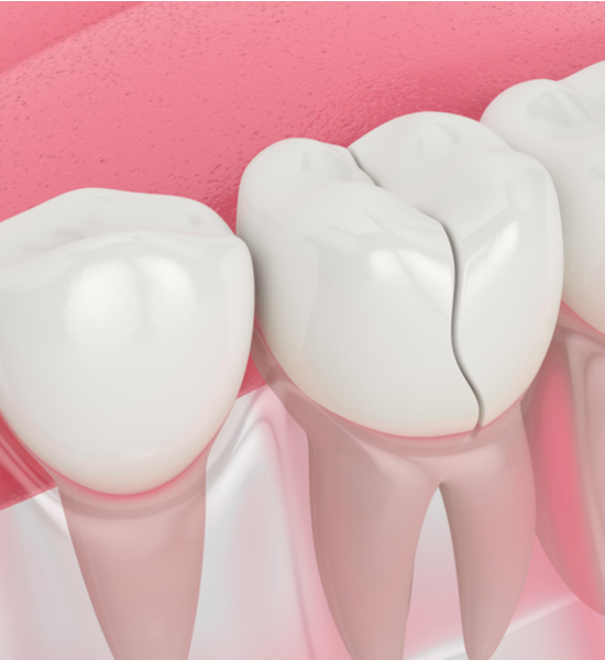 Endodontics | Aristo Dental