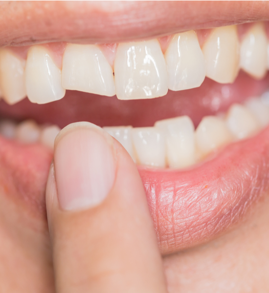 Cracked Tooth | Aristo Dental