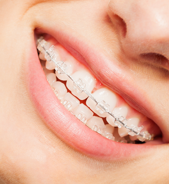 Orthodontic Services | Aristo Dental