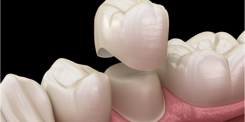 Which is Better - Dental Veneers or Crowns?