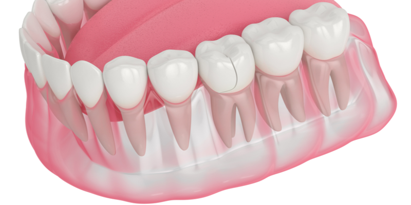 I Chipped a Tooth - What Should I Do? | Aristo Dental