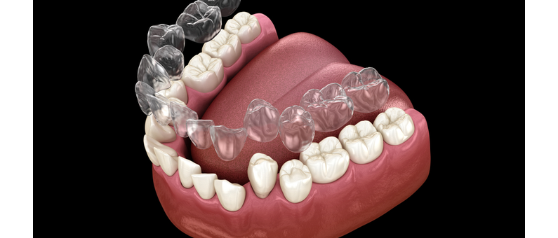 What Are The Benefits of Cosmetic Dentistry? | Aristo Dental